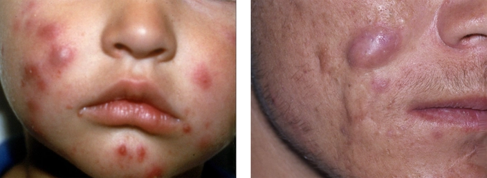 Acne Causes Image 2